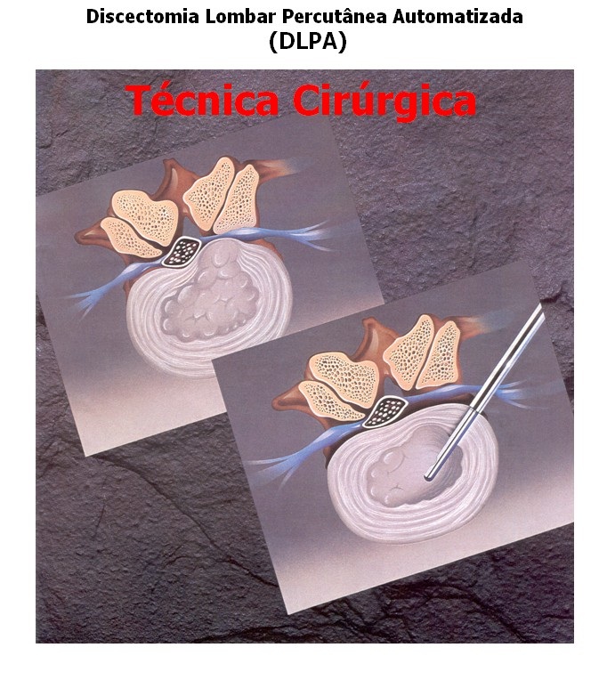 Nucleotomia